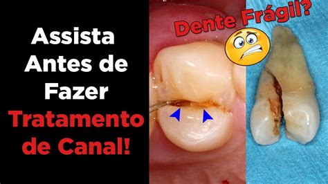 dente com canal - dente siso ou ciso